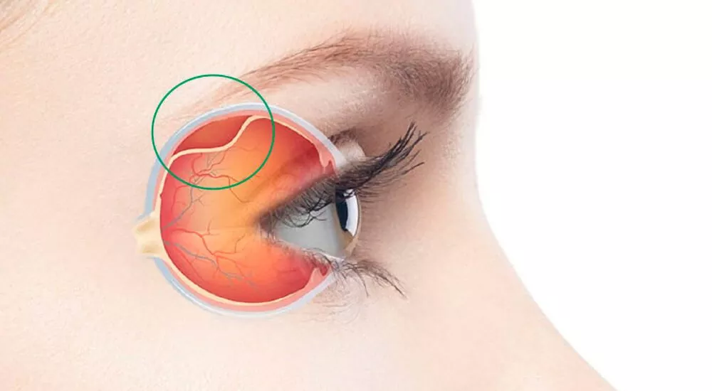 O que é Descolamento de Retina?