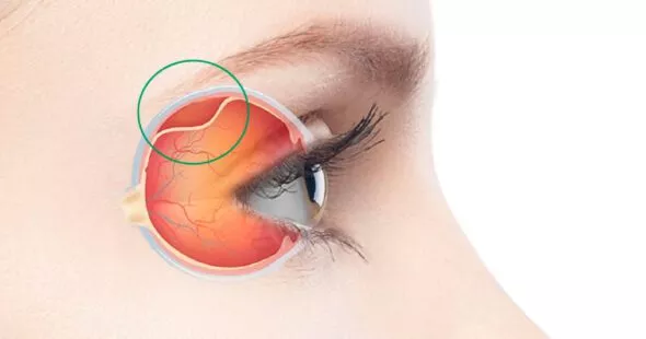 O que é Descolamento de Retina?