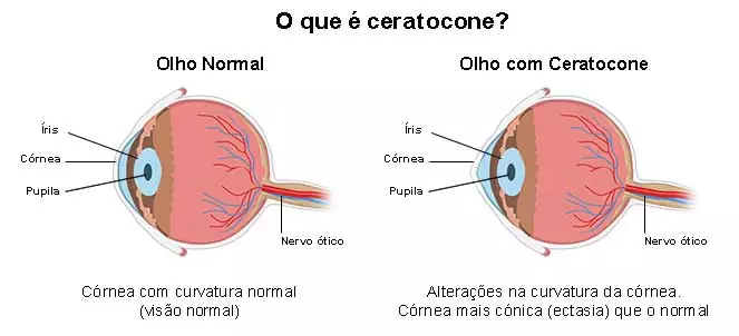 Cirurgia de Ceratocone