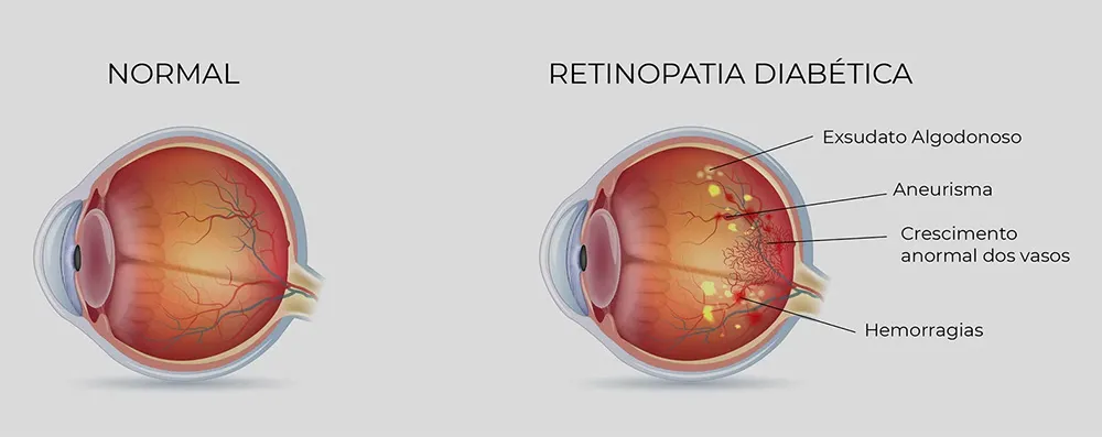 simulação de olho com retinopatia 