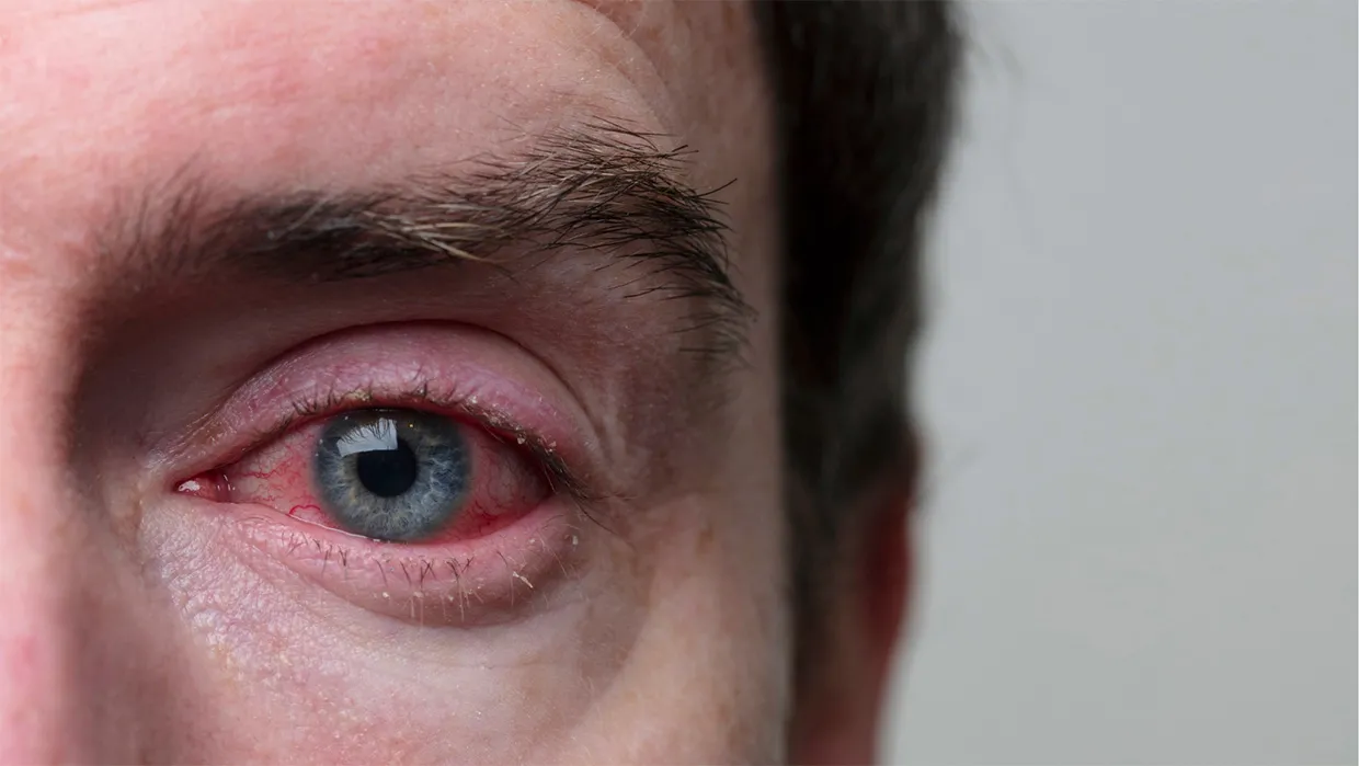 Conjuntivite Viral em Adultos