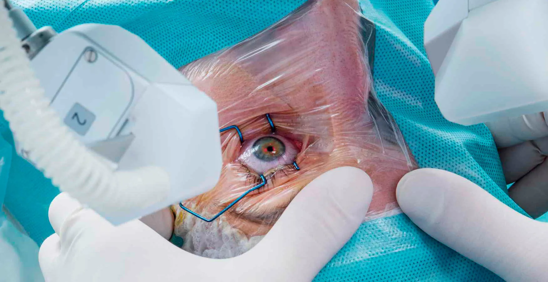 Cirurgia da Catarata a Laser é a Solução Moderna e Segura para uma Visão Renovada