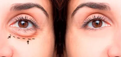 Desvende a Blefaroplastia: Indicações, Como é Feita, Recuperação e Benefícios para o Seu Olhar