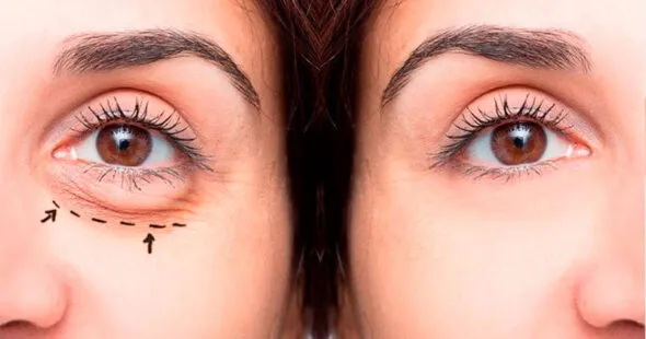 Desvende a Blefaroplastia: Indicações, Como é Feita, Recuperação e Benefícios para o Seu Olhar