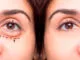 Desvende a Blefaroplastia: Indicações, Como é Feita, Recuperação e Benefícios para o Seu Olhar