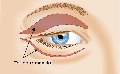 Ilustração simples mostrando diferentes problemas palpebrais: excesso de pele superior, bolsas inferiores.