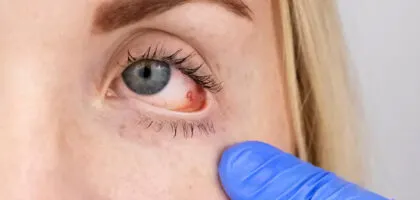 Lentes de Contato e Fungos: Entenda o Risco de Ceratite Fúngica e Como Proteger Seus Olhos