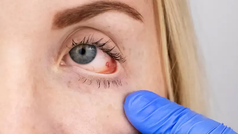 Lentes de Contato e Fungos: Entenda o Risco de Ceratite Fúngica e Como Proteger Seus Olhos