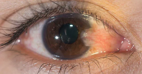 Pterígio - Mais do que um Detalhe Estético, um Alerta para a Saúde Ocular
