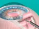 Cirurgia de Glaucoma – O Inimigo Silencioso