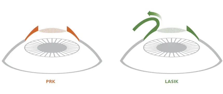 Cirurgia Refrativa – Diferenças: PRK vs. LASIK
